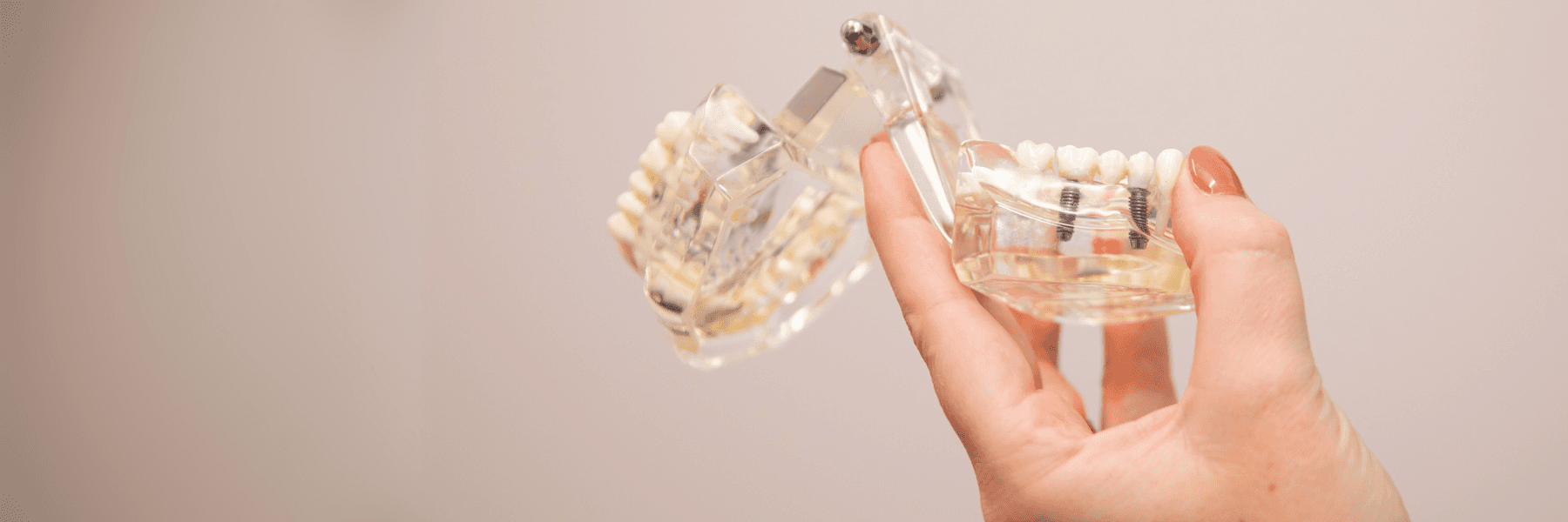 Dental Implants and Implant Dentures | Dentist