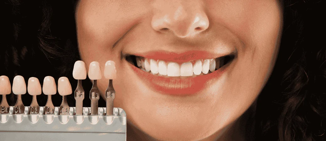 Veneers for Chipped Teeth: What to Know Before You Commit